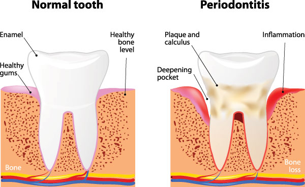 Benecchi Dental Group | Periodontal Treatment, Root Canals and Dental Cleanings
