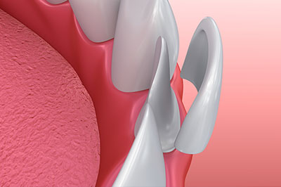 Benecchi Dental Group | Root Canals, Preventative Program and Dentures