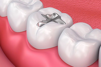 Benecchi Dental Group | Pediatric Dentistry, Periodontal Treatment and Dentures