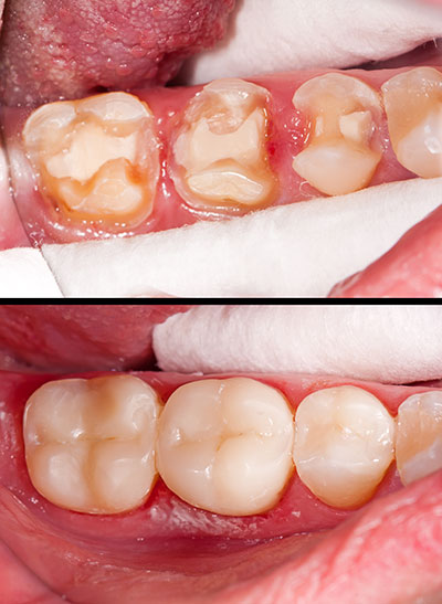 Benecchi Dental Group | Digital Radiography, Periodontal Treatment and Veneers