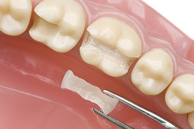 Benecchi Dental Group | Periodontal Treatment, Extractions and Crowns  amp  Caps